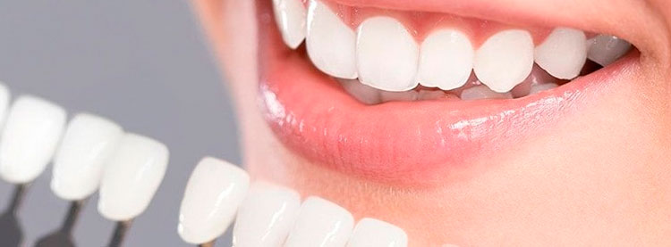 blanqueamiento dental en Denticlinic