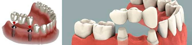 implantes dentales en denticlinic