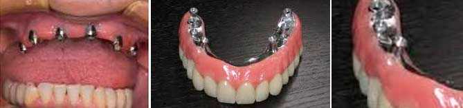 implantes dentales en denticlinic